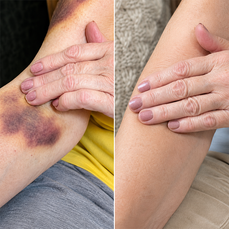 LIMETOW® Arnica Bruise Repair Oil
