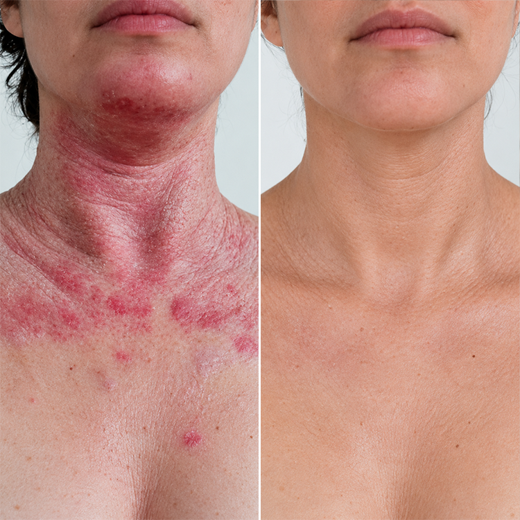 LIMETOW® Advanced Eczema Relief Therapy Cream! Powerful Eczema