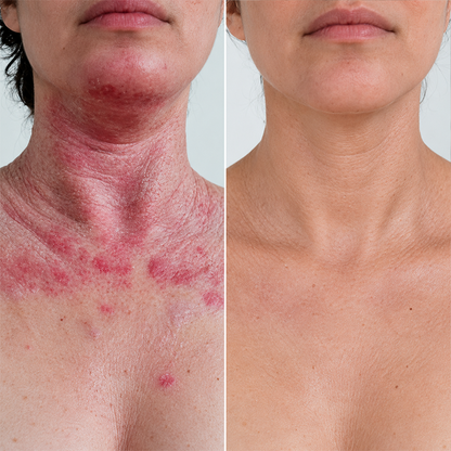 LIMETOW® Advanced Eczema Relief Therapy Cream! Powerful Eczema