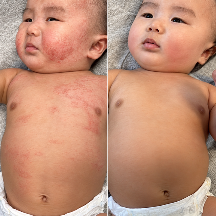 LIMETOW® Advanced Eczema Relief Therapy Cream! Powerful Eczema