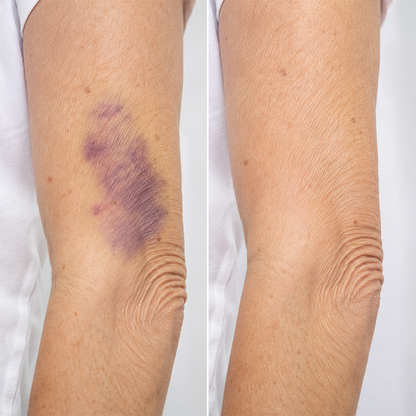 LIMETOW® Arnica Bruise Repair Oil