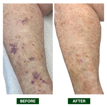 LIMETOW® Arnica Bruise Repair Oil