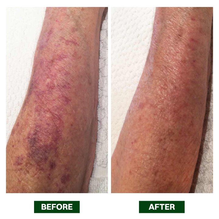 LIMETOW® Arnica Bruise Repair Oil