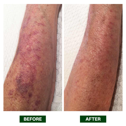 LIMETOW® Arnica Bruise Repair Oil