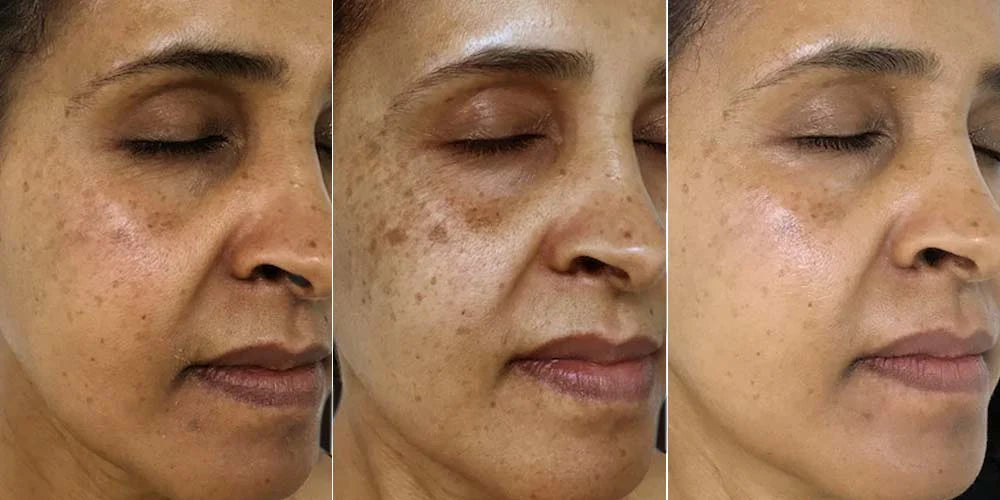 Dark Spot Corrector | Buy More, Save More!