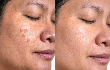 Dark Spot Corrector | Buy More, Save More!
