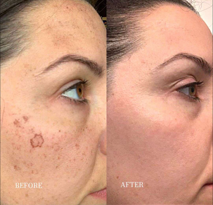 Dark Spot Corrector | Buy More, Save More!