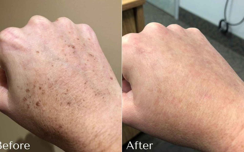 Dark Spot Corrector | Buy More, Save More!