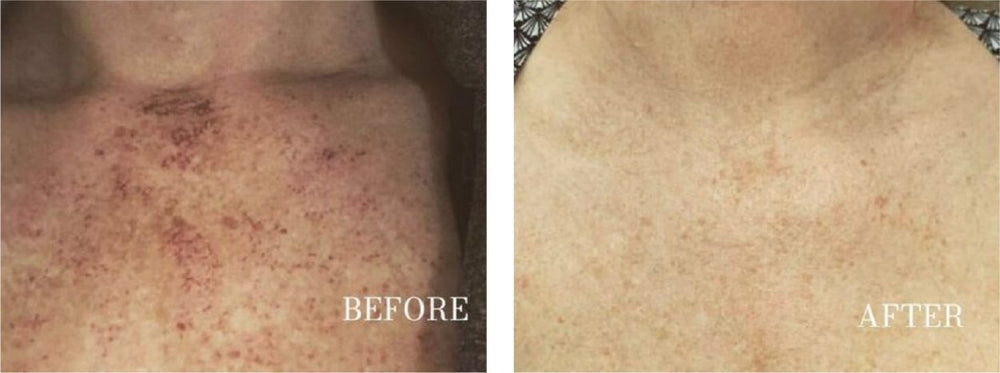 Dark Spot Corrector | Buy More, Save More!