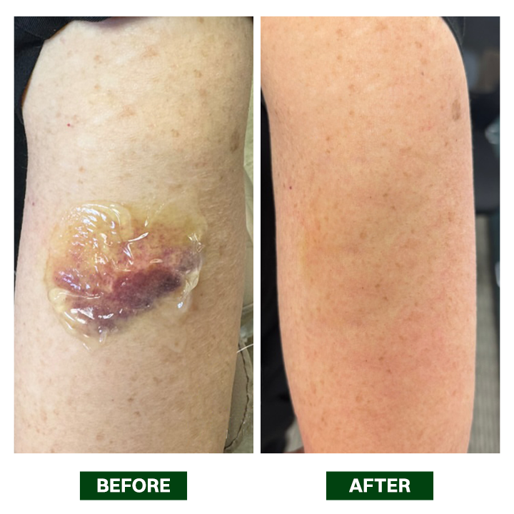 LIMETOW® Arnica Bruise Repair Oil
