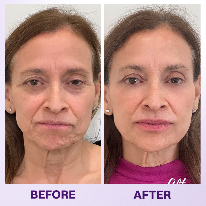 LIMETOW® INSTANT LIFT EYE GEL