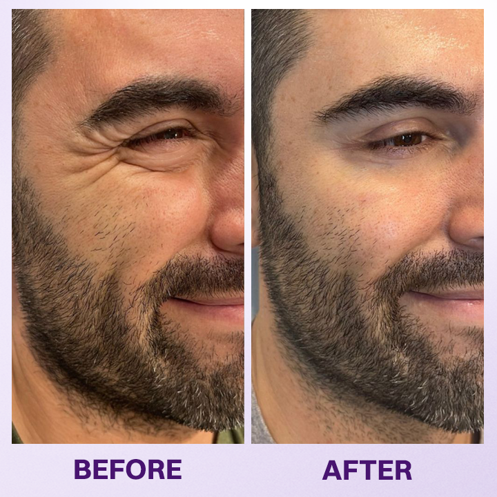 LIMETOW® INSTANT LIFT EYE GEL