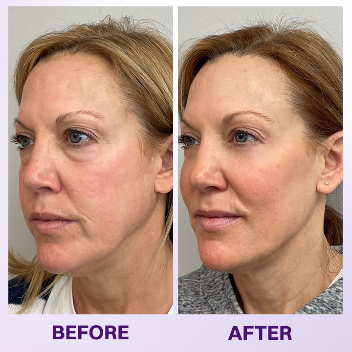 LIMETOW® INSTANT LIFT EYE GEL